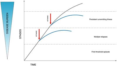 Short-term ketamine use in bipolar depression: a review of the evidence for short-term treatment management